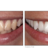 WHITENESS Perfect 22% KIT - Imagen 4
